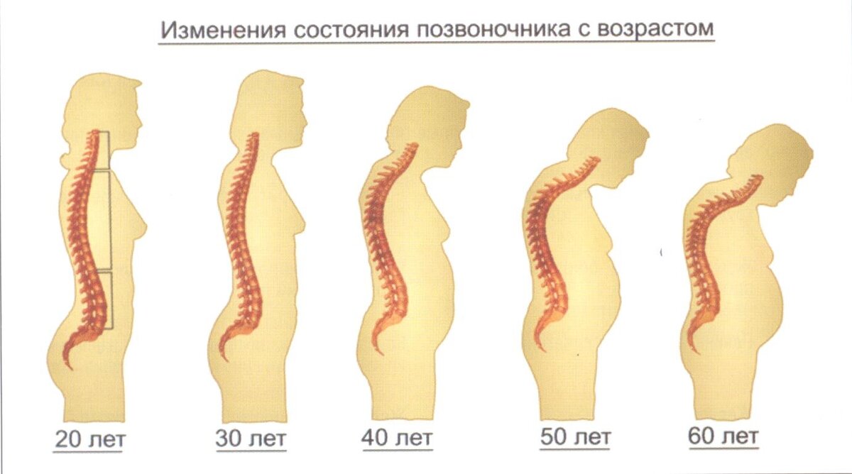 сутулость от большой груди фото 50